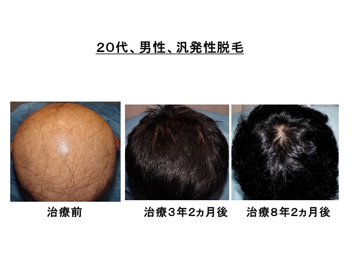 円形脱毛症　病院